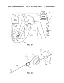 SYSTEM FOR PLACEMENT OF A CATHETER INCLUDING A SIGNAL-GENERATING STYLET diagram and image