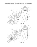 SYSTEM FOR PLACEMENT OF A CATHETER INCLUDING A SIGNAL-GENERATING STYLET diagram and image