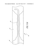 CATHETER WITH MULTIPLE ULTRASOUND RADIATING MEMBERS diagram and image