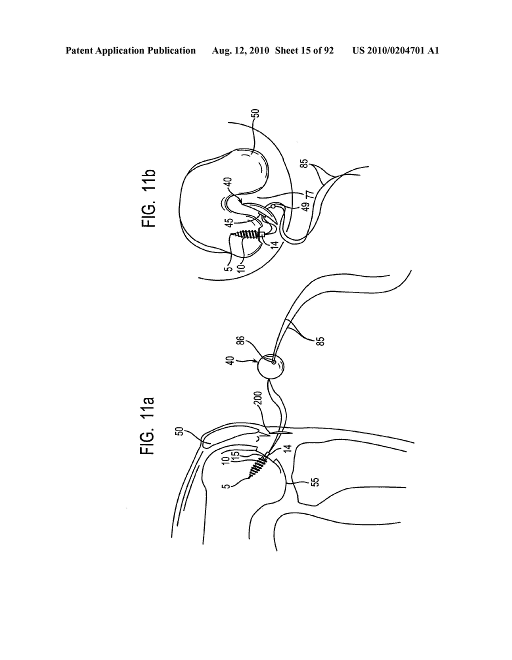 System and Method for Joint Resurface Repair - diagram, schematic, and image 16