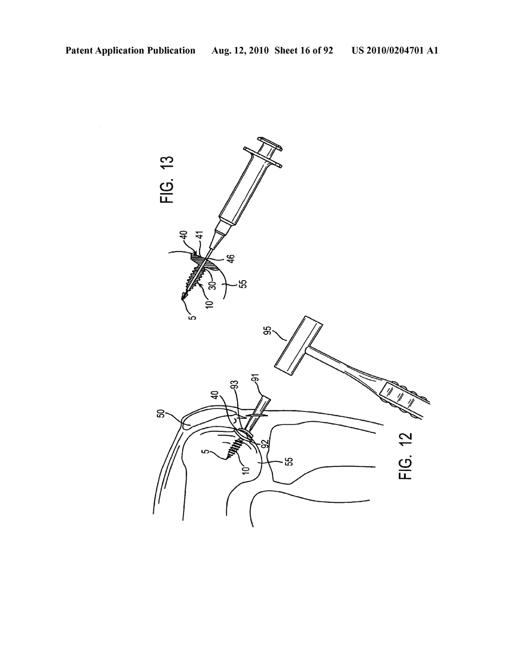 System and Method for Joint Resurface Repair - diagram, schematic, and image 17