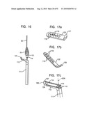 System and Method for Joint Resurface Repair diagram and image