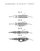 System and Method for Joint Resurface Repair diagram and image