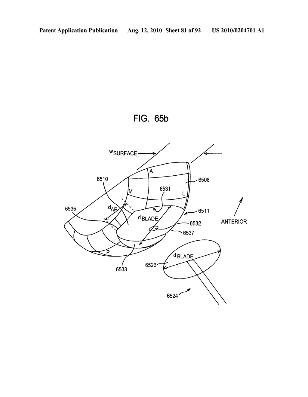 System and Method for Joint Resurface Repair - diagram, schematic, and image 82