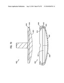 System and Method for Joint Resurface Repair diagram and image