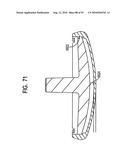 System and Method for Joint Resurface Repair diagram and image