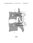 OSTEOSYNTHESIS SYSTEM FOR CONNECTING AT LEAST TWO VERTEBRAE diagram and image