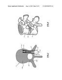 OSTEOSYNTHESIS SYSTEM FOR CONNECTING AT LEAST TWO VERTEBRAE diagram and image