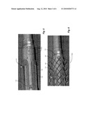 DELIVERY SYSTEM FOR INTRAVASCULAR DEVICE WITH NETTING diagram and image