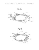 Single optic accommodative intraocular lens system diagram and image