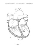 Method for percutaneous lateral access to the left ventricle for treatment of mitral insufficiency by papillary muscle alignment diagram and image