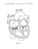 Method for percutaneous lateral access to the left ventricle for treatment of mitral insufficiency by papillary muscle alignment diagram and image