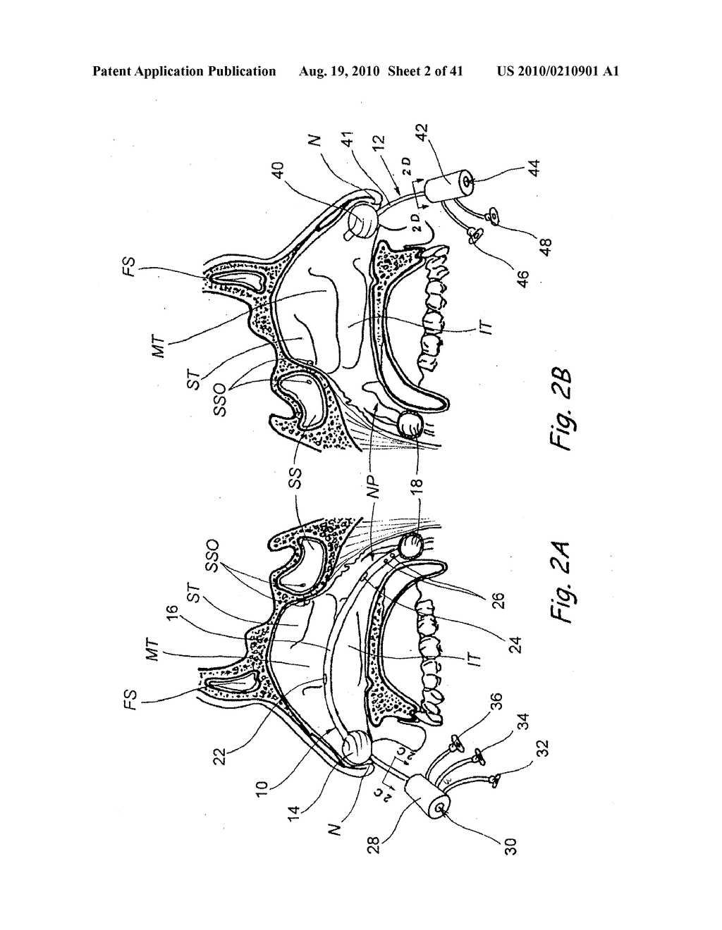 Devices, Systems and Methods For Diagnosing and Treating Sinusitis and Other Disorders of the Ears, Nose and/or Throat - diagram, schematic, and image 03