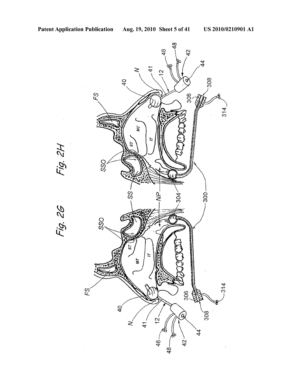 Devices, Systems and Methods For Diagnosing and Treating Sinusitis and Other Disorders of the Ears, Nose and/or Throat - diagram, schematic, and image 06