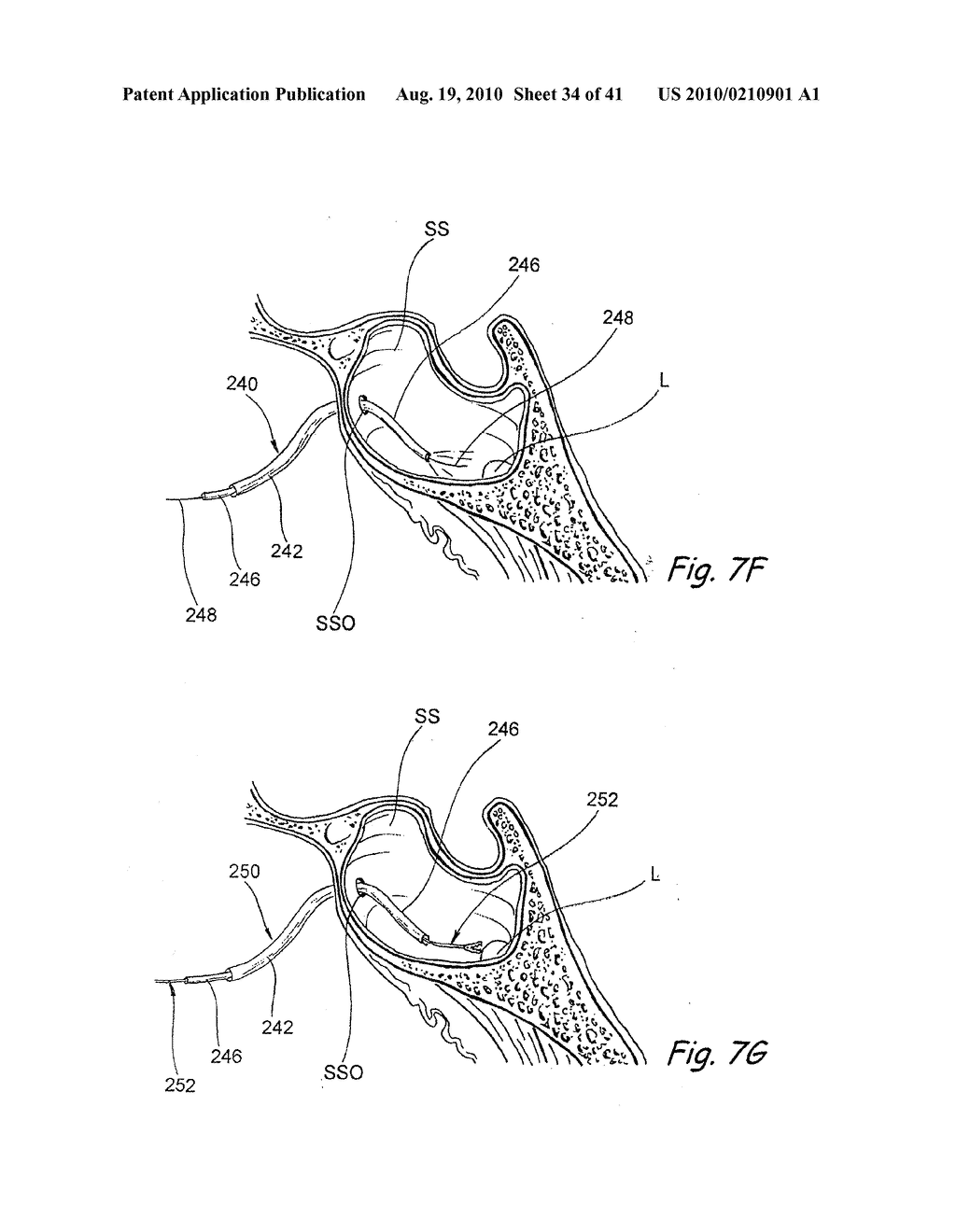 Devices, Systems and Methods For Diagnosing and Treating Sinusitis and Other Disorders of the Ears, Nose and/or Throat - diagram, schematic, and image 35