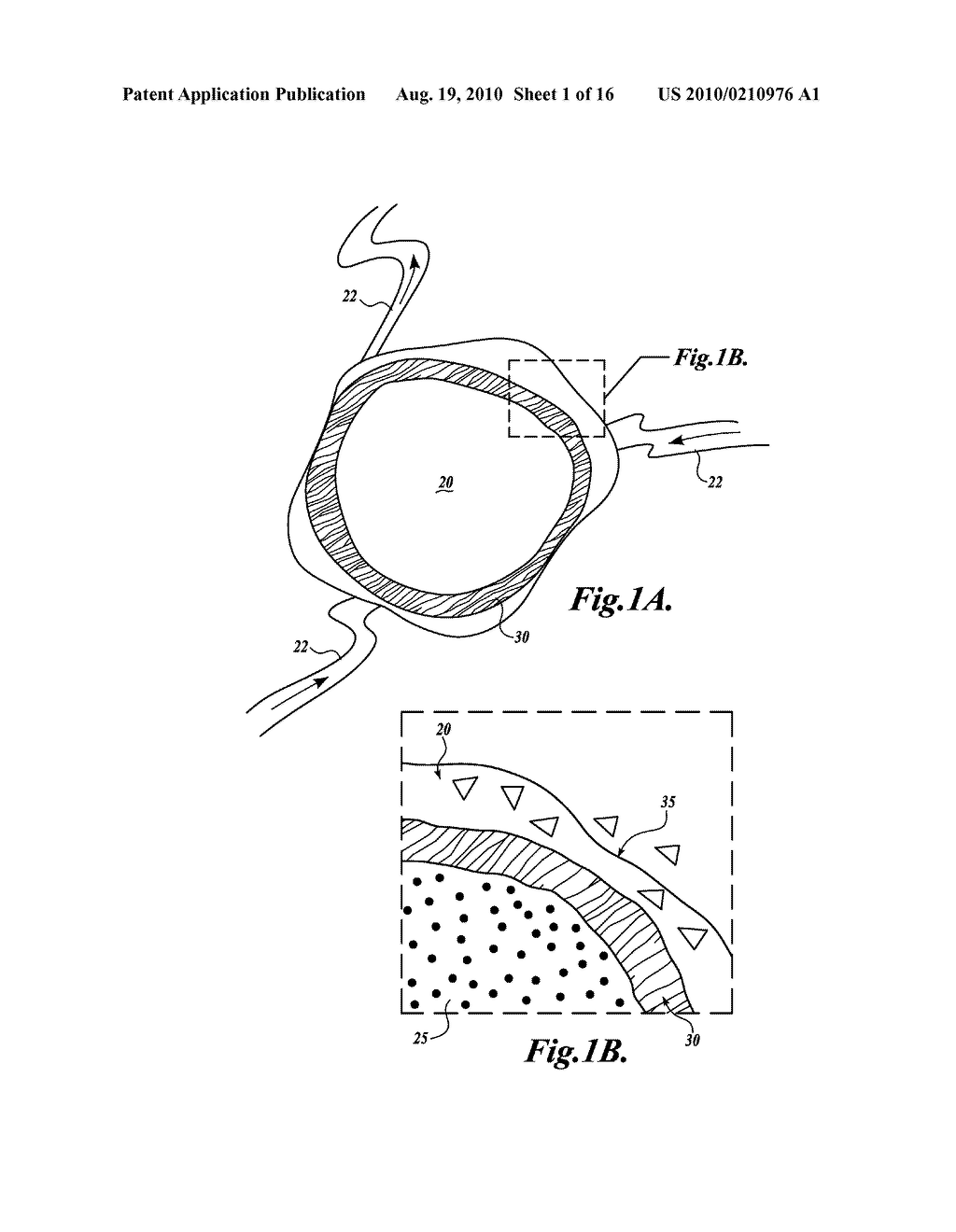 METHOD AND APPARATUS FOR TREATING TISSUES WITH HIFU - diagram, schematic, and image 02