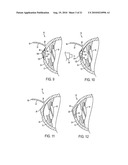 METHOD FOR LASER CORRECTION OF REFRACTIVE ERRORS OF AN EYE WITH A THIN CORNEA diagram and image