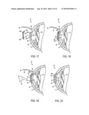 METHOD FOR LASER CORRECTION OF REFRACTIVE ERRORS OF AN EYE WITH A THIN CORNEA diagram and image