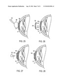 METHOD FOR LASER CORRECTION OF REFRACTIVE ERRORS OF AN EYE WITH A THIN CORNEA diagram and image