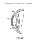 METHOD FOR LASER CORRECTION OF REFRACTIVE ERRORS OF AN EYE WITH A THIN CORNEA diagram and image