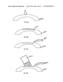 METHOD FOR LASER CORRECTION OF REFRACTIVE ERRORS OF AN EYE WITH A THIN CORNEA diagram and image