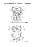 METHODS AND DEVICES FOR REMOVING OMENTAL TISSUE diagram and image