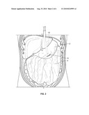 METHODS AND DEVICES FOR REMOVING OMENTAL TISSUE diagram and image