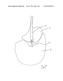 METHODS AND DEVICES FOR REMOVING OMENTAL TISSUE diagram and image