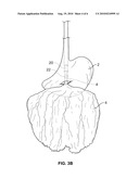 METHODS AND DEVICES FOR REMOVING OMENTAL TISSUE diagram and image