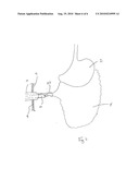 METHODS AND DEVICES FOR REMOVING OMENTAL TISSUE diagram and image