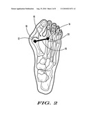 METHODS AND DEVICES FOR TREATING HALLUX VALGUS diagram and image