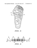 METHODS AND DEVICES FOR TREATING HALLUX VALGUS diagram and image