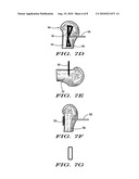 METHODS AND DEVICES FOR TREATING HALLUX VALGUS diagram and image