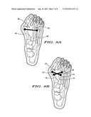 METHODS AND DEVICES FOR TREATING HALLUX VALGUS diagram and image