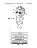 METHODS AND DEVICES FOR TREATING HALLUX VALGUS diagram and image