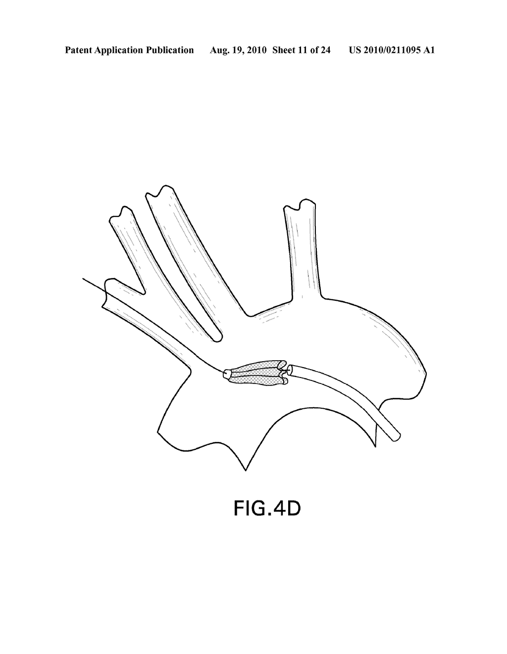 Embolic Protection Device and Method of Use - diagram, schematic, and image 12