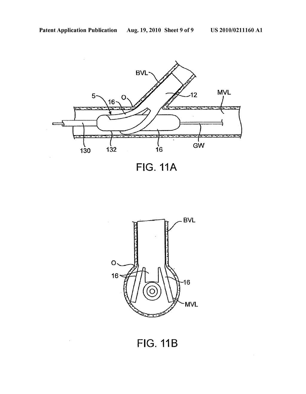 PROSTHESIS FOR PLACEMENT AT A LUMINAL OS - diagram, schematic, and image 10