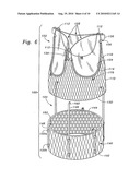 MINIMALLY-INVASIVE HEART VALVES diagram and image