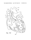 MINIMALLY-INVASIVE HEART VALVES diagram and image