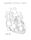 MINIMALLY-INVASIVE HEART VALVES diagram and image