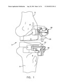 Method For Forming A Patient Specific Surgical Guide Mount diagram and image