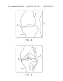 Method For Forming A Patient Specific Surgical Guide Mount diagram and image