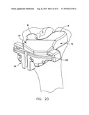 Method For Forming A Patient Specific Surgical Guide Mount diagram and image