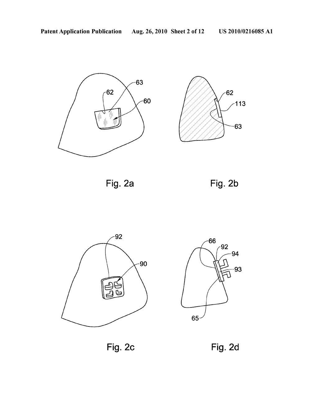 Method, system and model for indirect bonding - diagram, schematic, and image 03