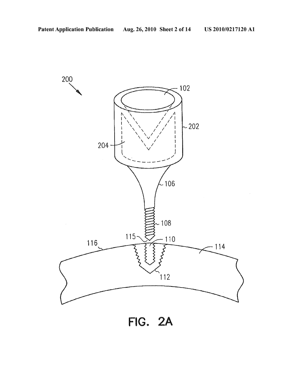 Fiducial Marker Devices, Tools, and Methods - diagram, schematic, and image 03