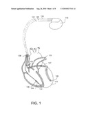 METHODS AND SYSTEMS TO CORRELATE ARRHYTHMIC AND ISCHEMIC EVENTS diagram and image