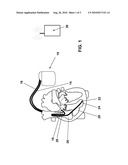 TECHNIQUE FOR DETERMINING SIGNAL QUALITY IN A PHYSIOLOGIC SENSING SYSTEM USING HIGH FREQUENCY SAMPLING diagram and image