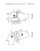 SENSING FORCE DURING PARTIAL AND TOTAL KNEE REPLACEMENT SURGERY diagram and image