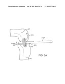 SENSING FORCE DURING PARTIAL AND TOTAL KNEE REPLACEMENT SURGERY diagram and image