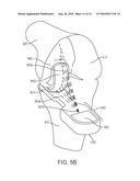 SENSING FORCE DURING PARTIAL AND TOTAL KNEE REPLACEMENT SURGERY diagram and image